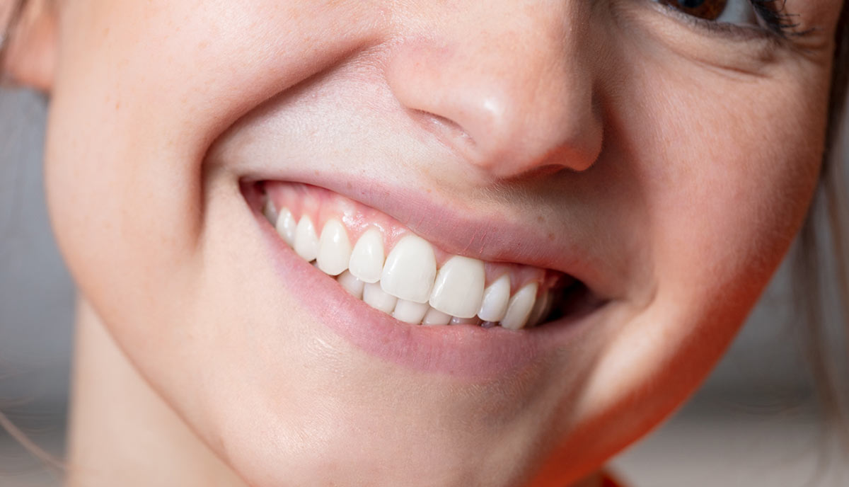 Schönen Zähne und ein bezauberndes Lächeln dank Veneers. Ästhetische Zahnmedizin in unserer Praxis in Herzogenrath.