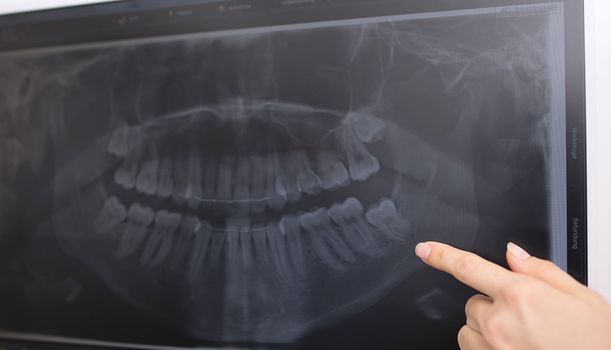 Röntgenaufnahme des Kiefers zur schonenden Behandlung in der Oralchirurgie Herzogenrath.